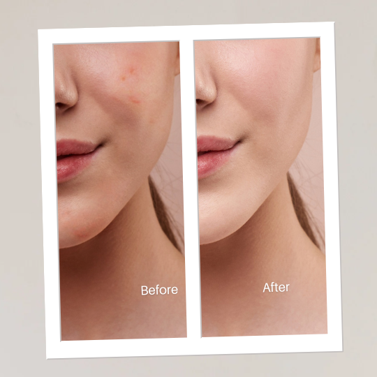 acne specialist Brampton