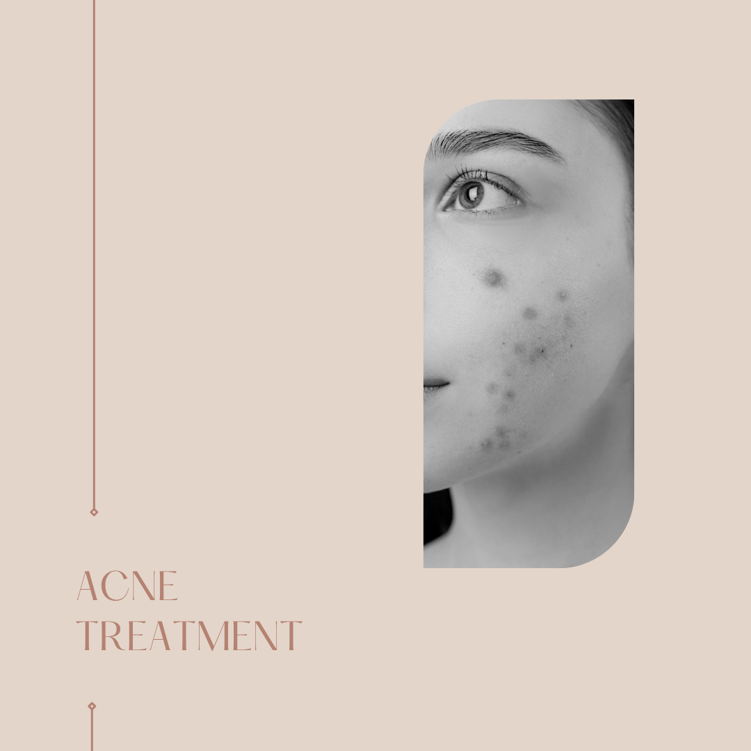 acne solutions Brampton