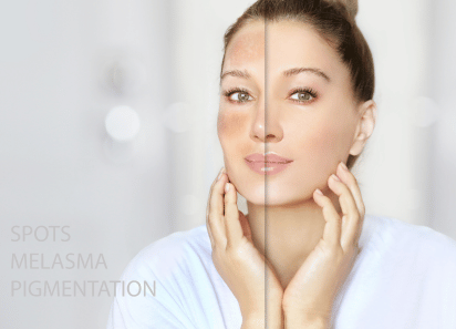 Pigmentation, Dark Spots and Melasma Treatment in Brampton